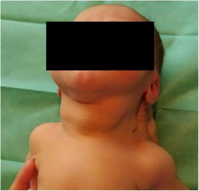 Unusual congenital goiter due to maternal Hashimoto thyroiditis: a case report